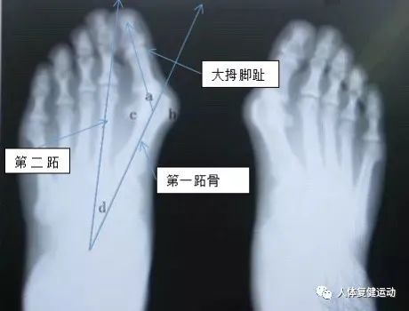 〖科普〗拇指外翻怎么办?如何纠正呢?