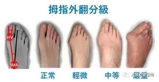 〖科普〗拇指外翻怎么办?如何纠正呢?