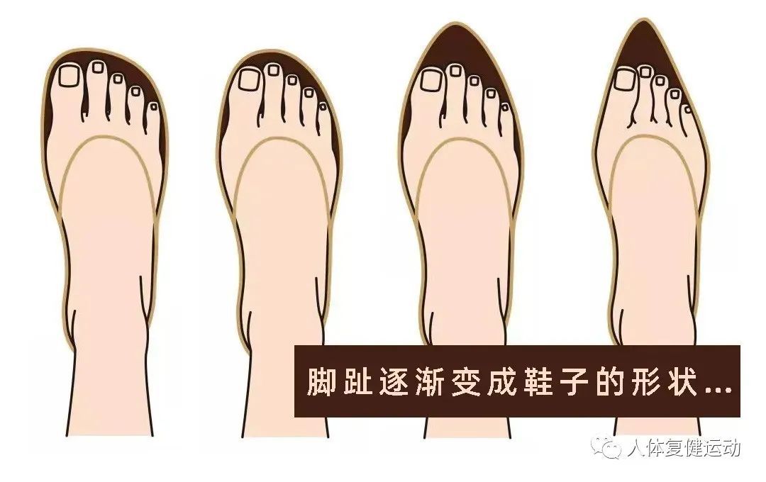 〖科普〗拇指外翻怎么办？如何纠正呢？
