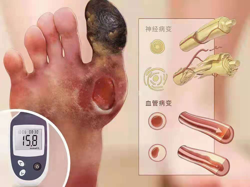 糖尿病足科普知识