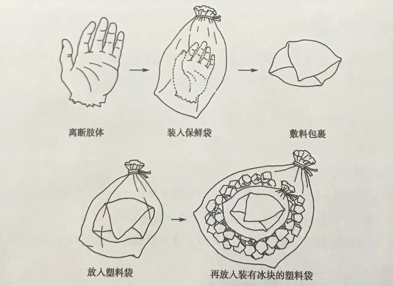 断肢（指）如何急救？