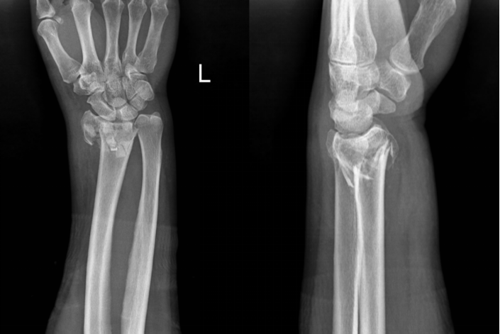 老人郊游摔倒致骨折不知所措，恰逢好心司机曾是重庆长城骨科医院病友