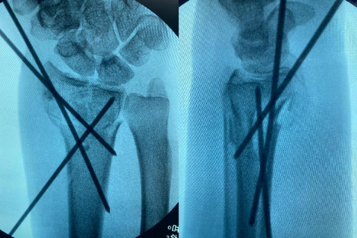 老人郊游摔倒致骨折不知所措，恰逢好心司机曾是重庆长城骨科医院病友