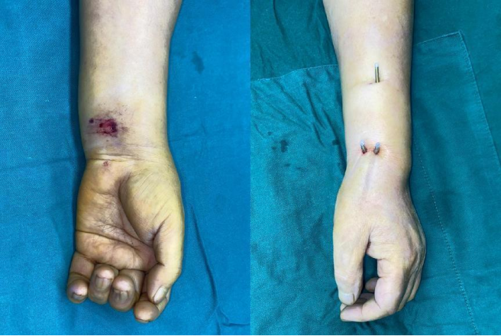 老人郊游摔倒致骨折不知所措，恰逢好心司机曾是重庆长城骨科医院病友